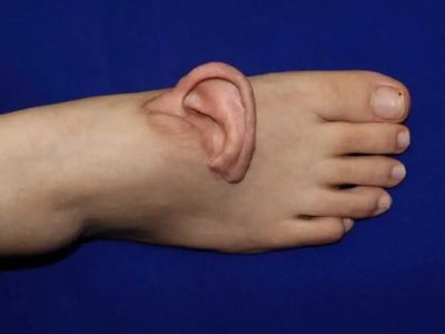 گوش برای اولین بار به پا پیوند زده شد